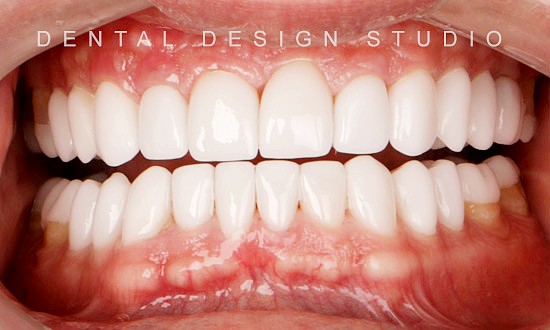 before and after dentist in cancun